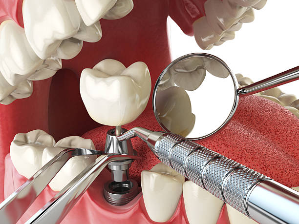Best Emergency Wisdom Tooth Extraction in Eau Claire, WI